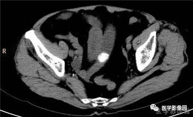 【病例】柿石引起的肠梗阻1例CT 【病例】柿石引起的肠梗阻1例CT