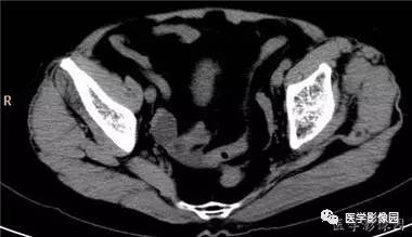 【病例】柿石引起的肠梗阻1例CT 【病例】柿石引起的肠梗阻1例CT