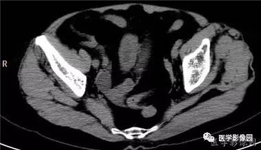 【病例】柿石引起的肠梗阻1例CT 【病例】柿石引起的肠梗阻1例CT