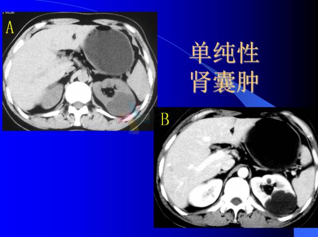 【PPT】肾脏囊性病变的CT诊断