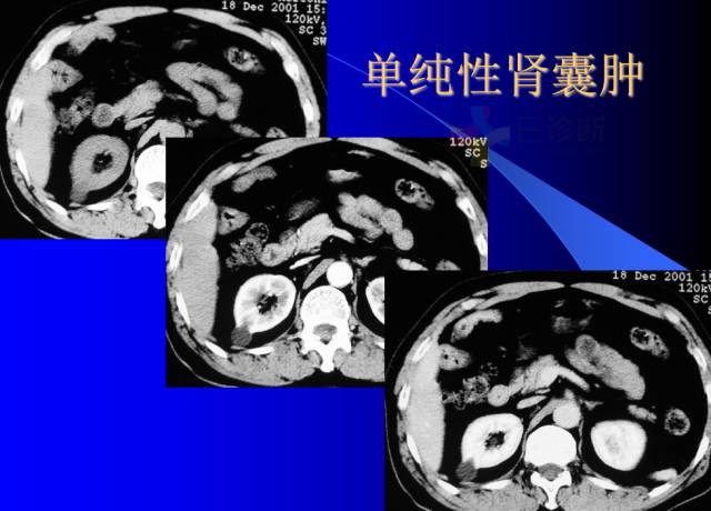 【PPT】肾脏囊性病变的CT诊断