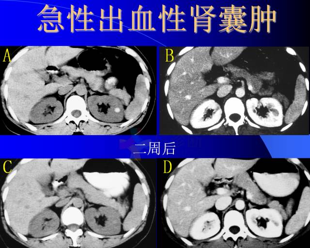 【PPT】肾脏囊性病变的CT诊断
