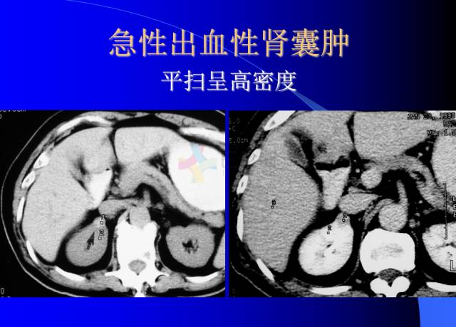 【PPT】肾脏囊性病变的CT诊断
