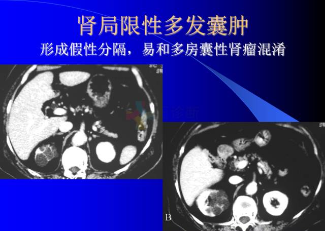 【PPT】肾脏囊性病变的CT诊断