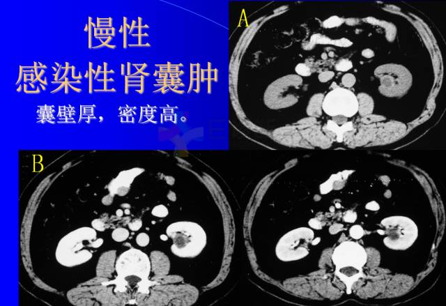 【PPT】肾脏囊性病变的CT诊断