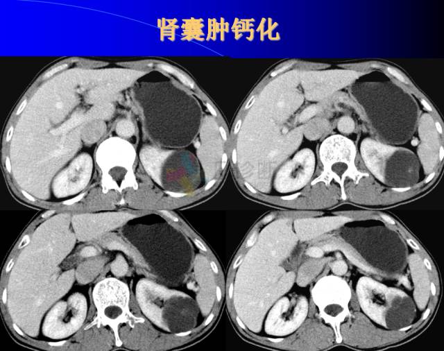 【PPT】肾脏囊性病变的CT诊断