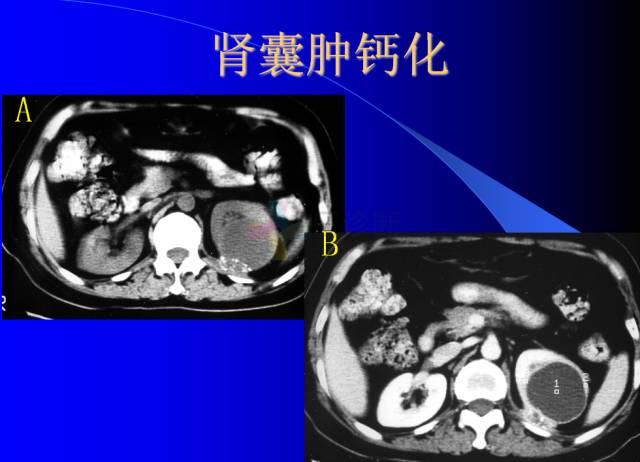 【PPT】肾脏囊性病变的CT诊断