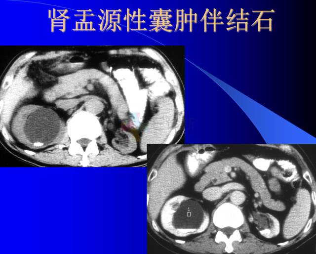 【PPT】肾脏囊性病变的CT诊断