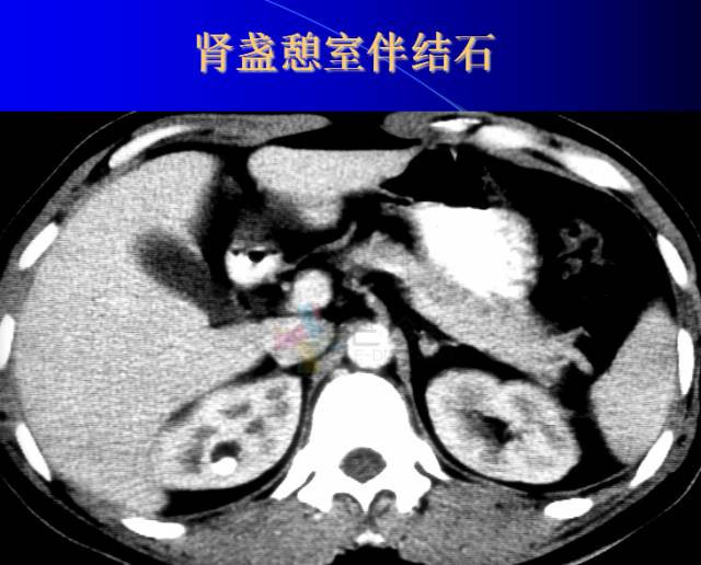 【PPT】肾脏囊性病变的CT诊断