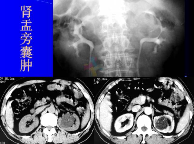【PPT】肾脏囊性病变的CT诊断