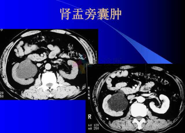 【PPT】肾脏囊性病变的CT诊断
