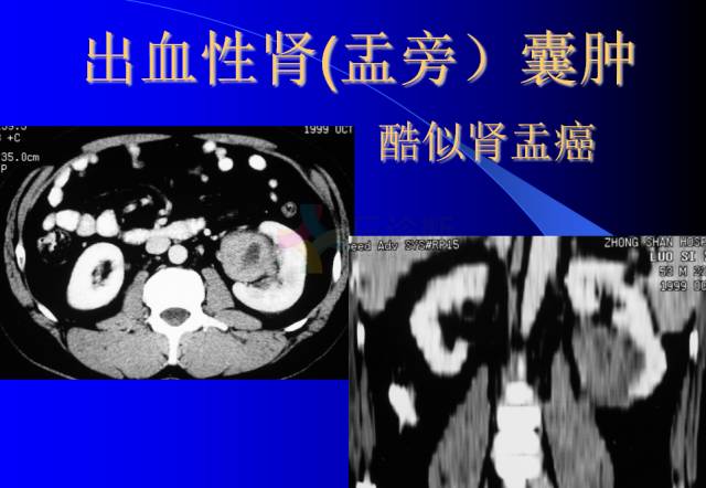 【PPT】肾脏囊性病变的CT诊断