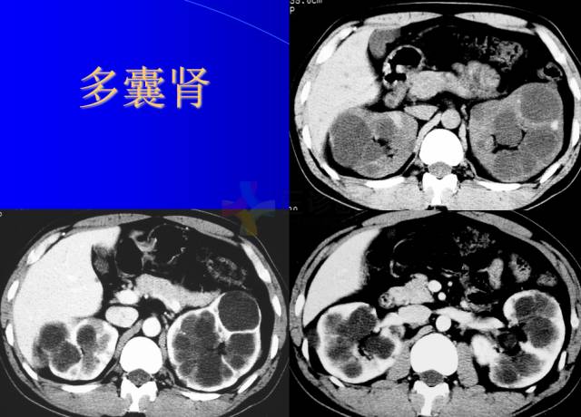 【PPT】肾脏囊性病变的CT诊断