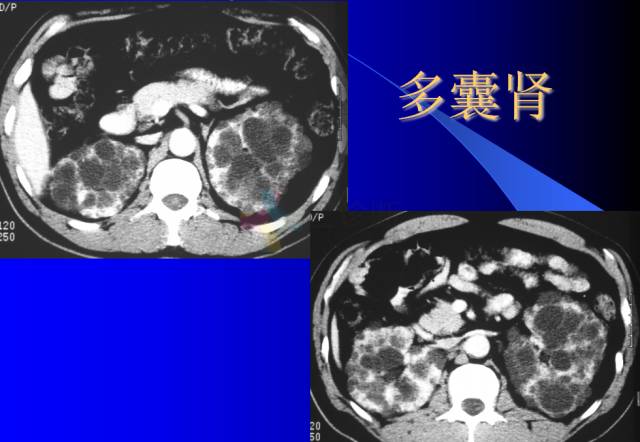 【PPT】肾脏囊性病变的CT诊断
