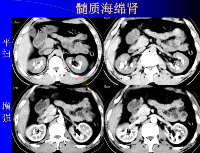【PPT】肾脏囊性病变的CT诊断