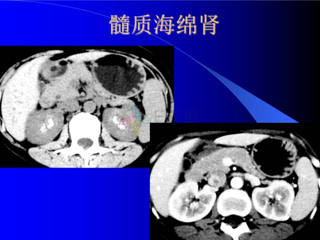 【PPT】肾脏囊性病变的CT诊断