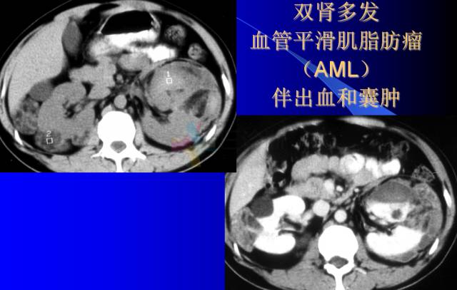 【PPT】肾脏囊性病变的CT诊断