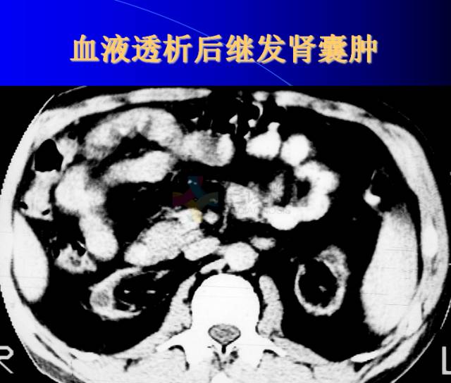 【PPT】肾脏囊性病变的CT诊断