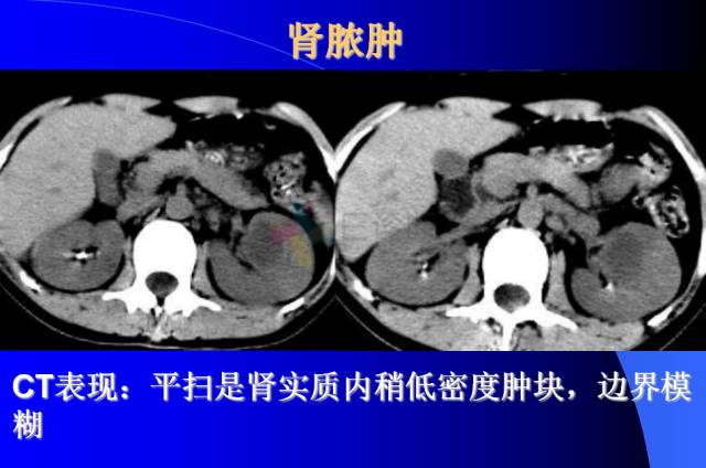 【PPT】肾脏囊性病变的CT诊断