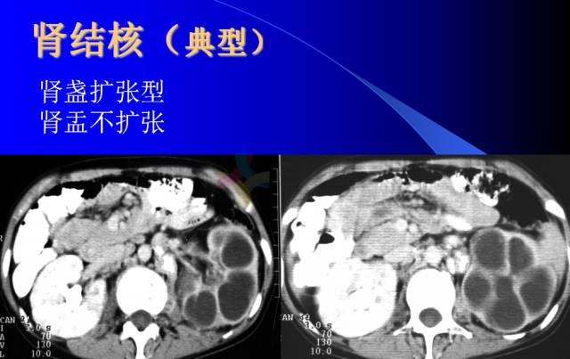 【PPT】肾脏囊性病变的CT诊断