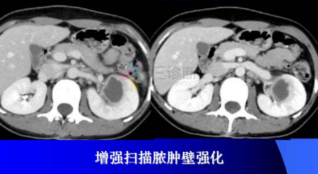 【PPT】肾脏囊性病变的CT诊断
