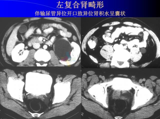【PPT】肾脏囊性病变的CT诊断