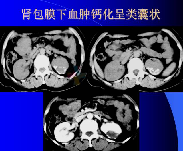 【PPT】肾脏囊性病变的CT诊断