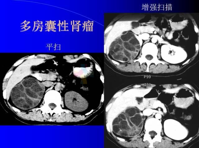 【PPT】肾脏囊性病变的CT诊断