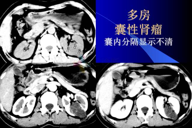 【PPT】肾脏囊性病变的CT诊断
