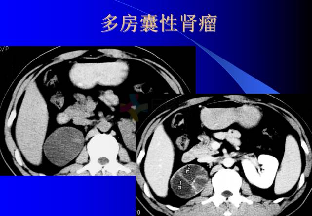 【PPT】肾脏囊性病变的CT诊断