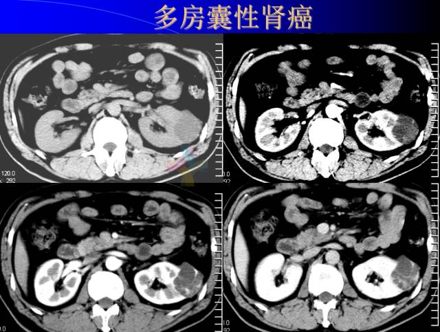 【PPT】肾脏囊性病变的CT诊断