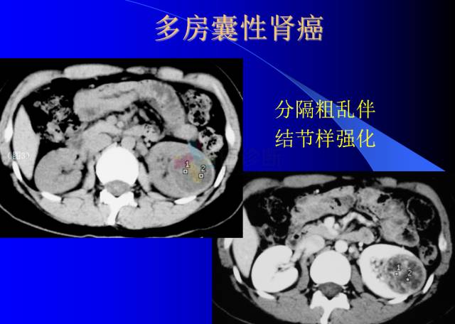 【PPT】肾脏囊性病变的CT诊断