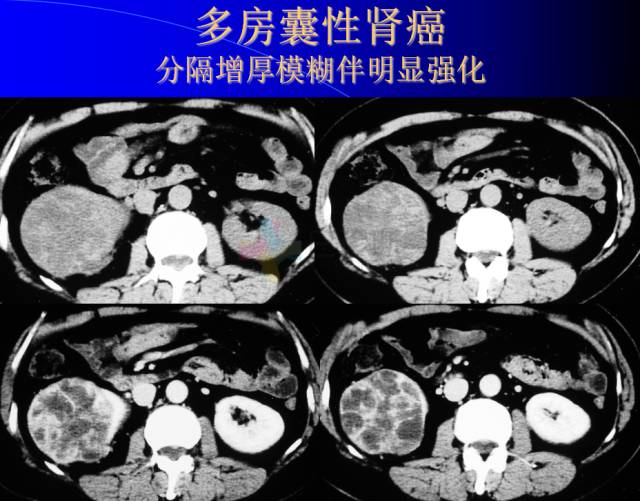 【PPT】肾脏囊性病变的CT诊断