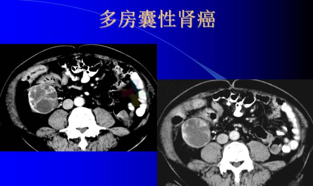 【PPT】肾脏囊性病变的CT诊断