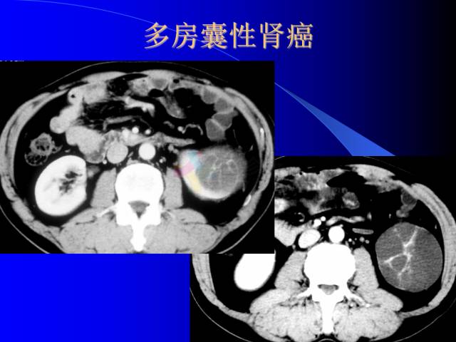 【PPT】肾脏囊性病变的CT诊断