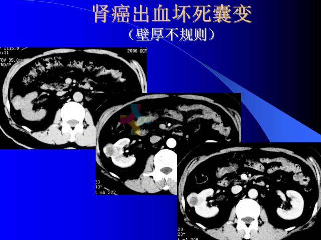【PPT】肾脏囊性病变的CT诊断