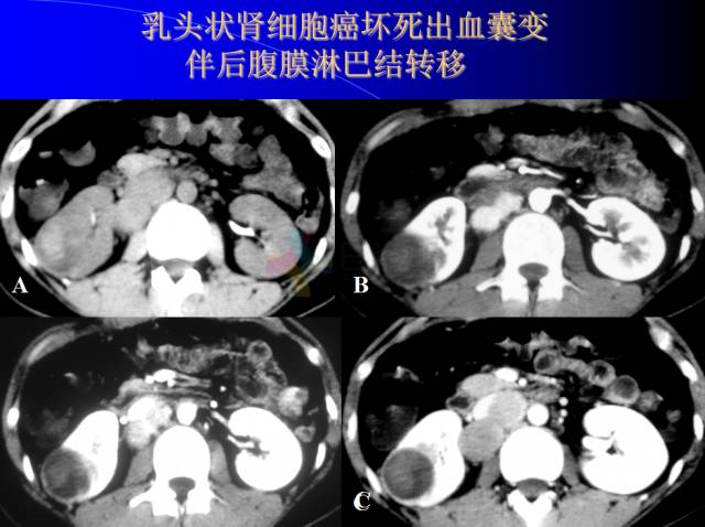 【PPT】肾脏囊性病变的CT诊断