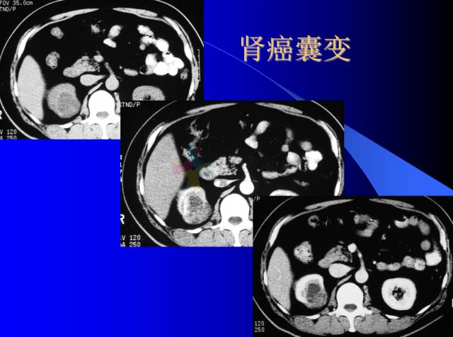 【PPT】肾脏囊性病变的CT诊断
