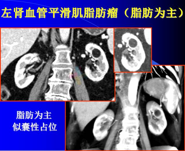 【PPT】肾脏囊性病变的CT诊断