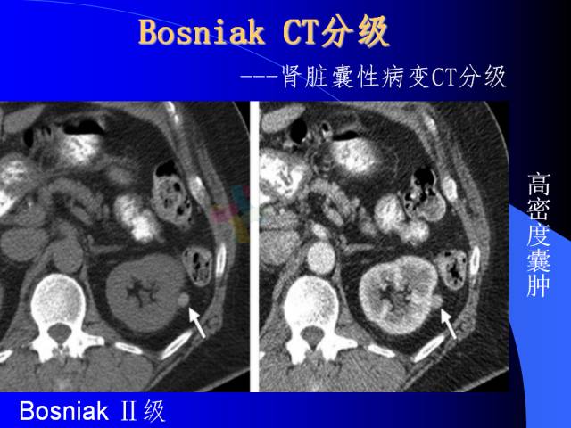 【PPT】肾脏囊性病变的CT诊断