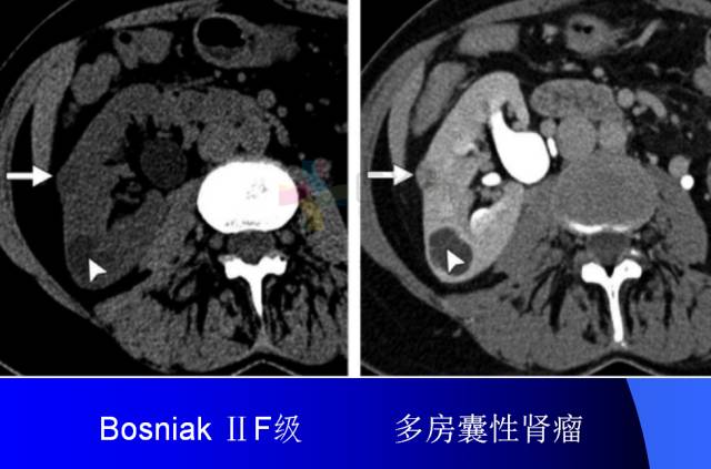 【PPT】肾脏囊性病变的CT诊断