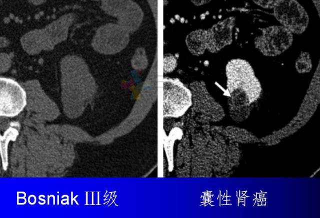 【PPT】肾脏囊性病变的CT诊断