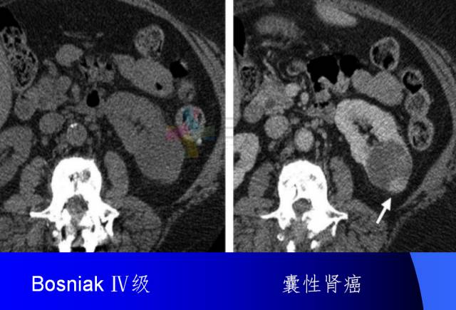 【PPT】肾脏囊性病变的CT诊断