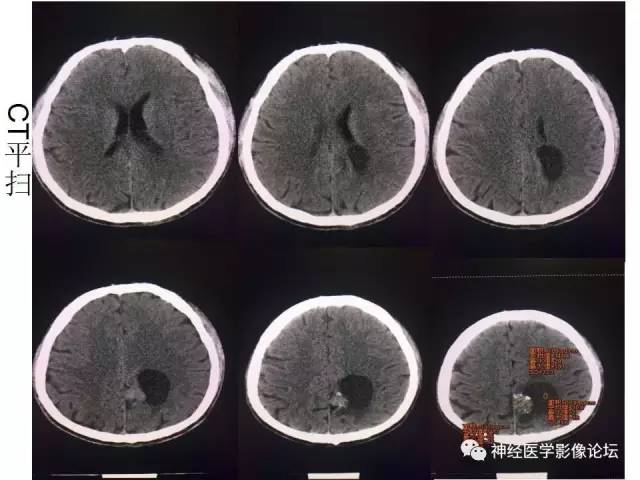 【病例】左顶叶部非典型囊性脑膜瘤1例影像讨论