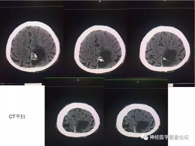 【病例】左顶叶部非典型囊性脑膜瘤1例影像讨论