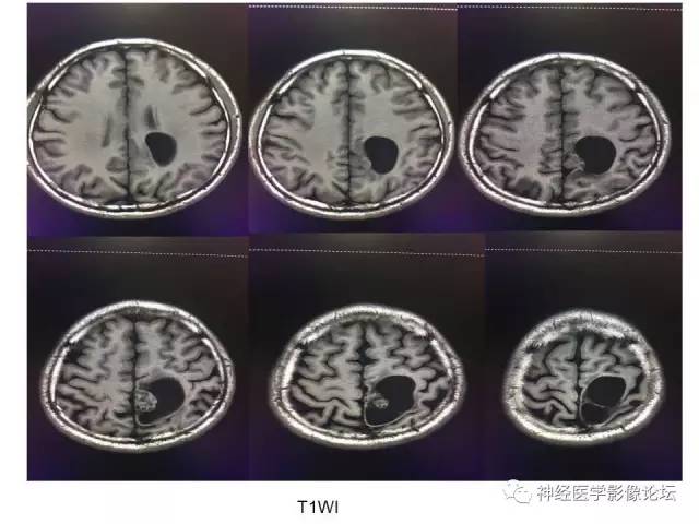 【病例】左顶叶部非典型囊性脑膜瘤1例影像讨论