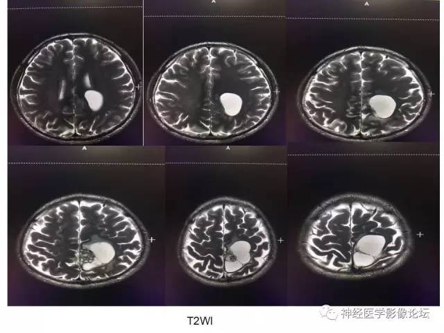 【病例】左顶叶部非典型囊性脑膜瘤1例影像讨论