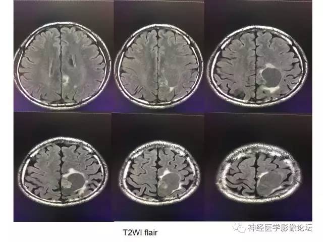 【病例】左顶叶部非典型囊性脑膜瘤1例影像讨论
