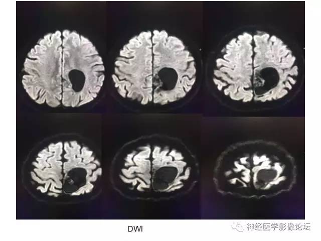 【病例】左顶叶部非典型囊性脑膜瘤1例影像讨论