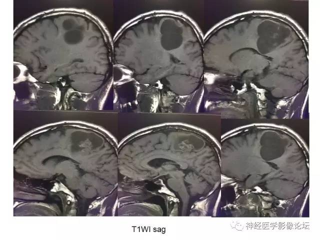 【病例】左顶叶部非典型囊性脑膜瘤1例影像讨论